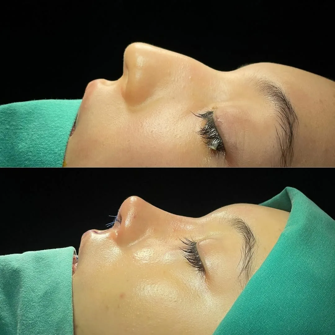 ultrasonic-rhinoplasty-5