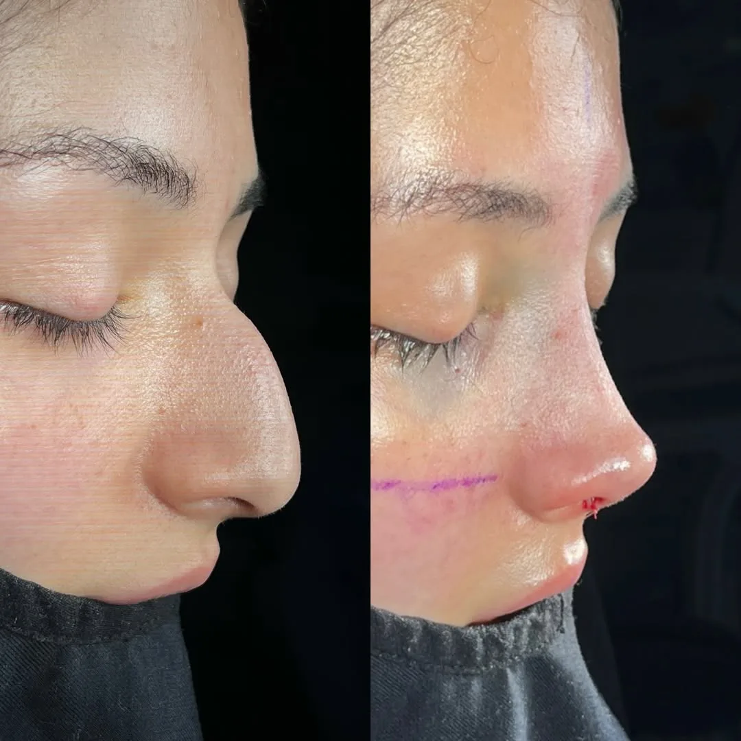 ultrasonic-rhinoplasty-6