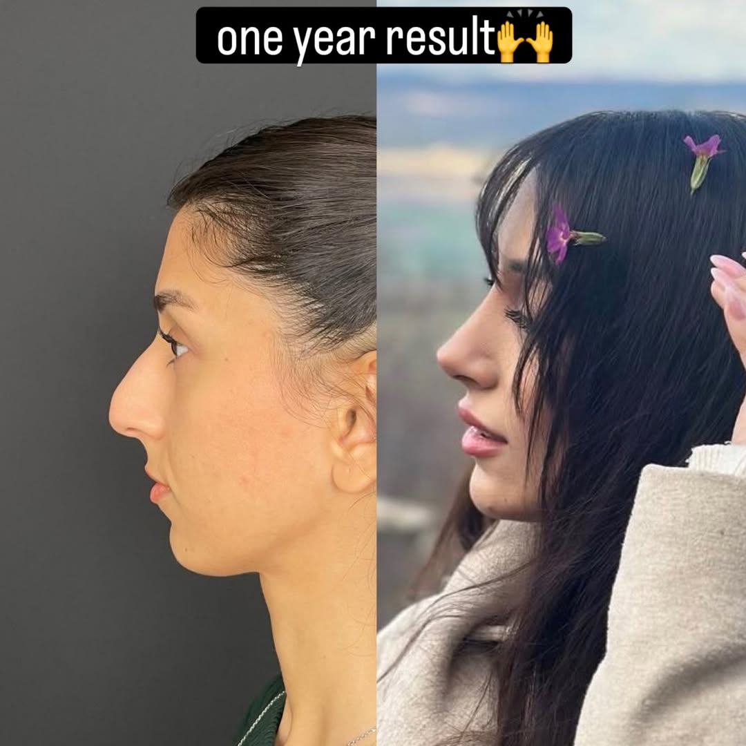 nose job in turkey, antalya-1 nose job in turkey, antalya-1