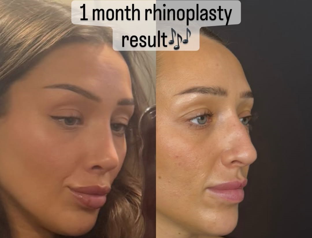 Things to Avoid After Rhinoplasty