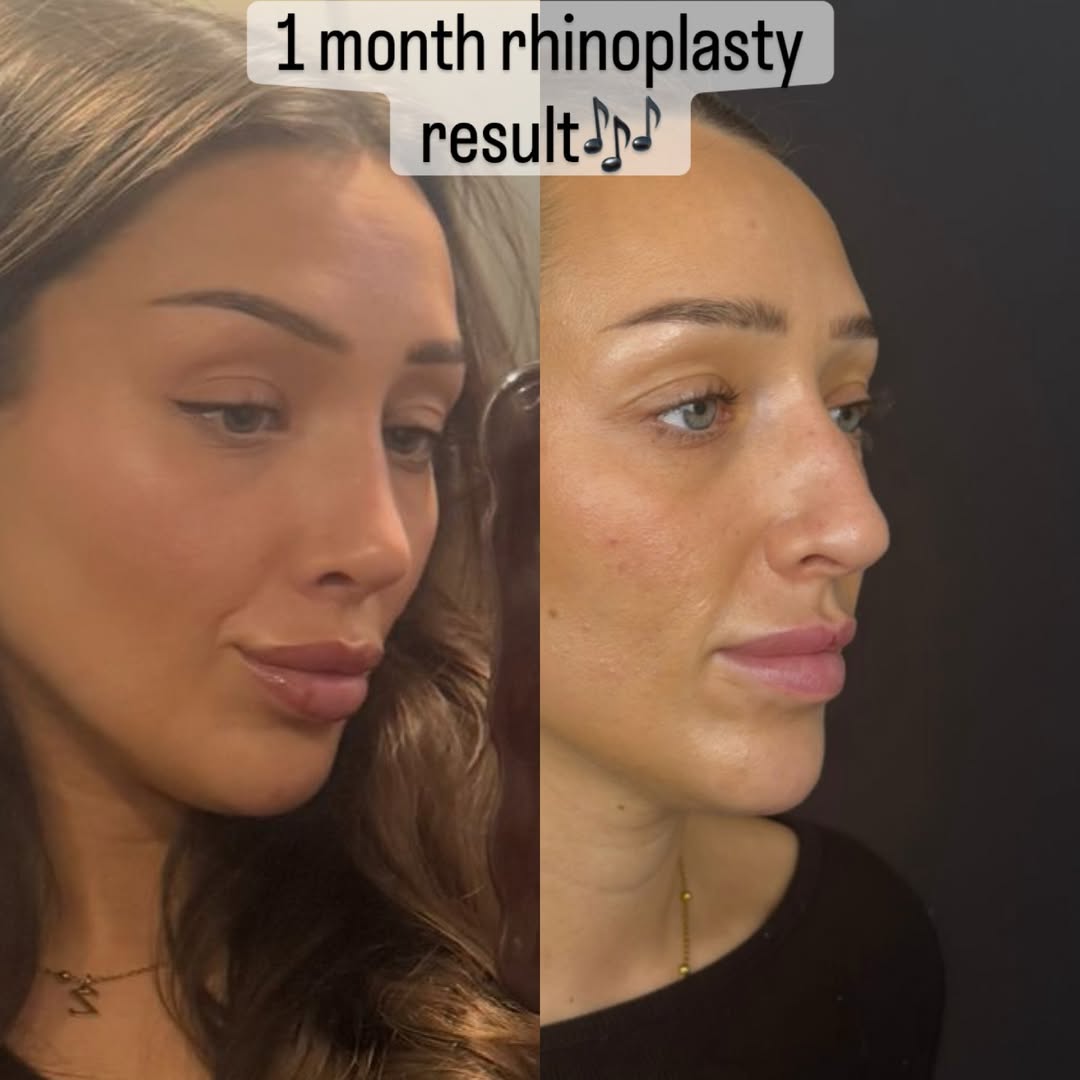 nose job in turkey, antalya-2 nose job in turkey, antalya-2