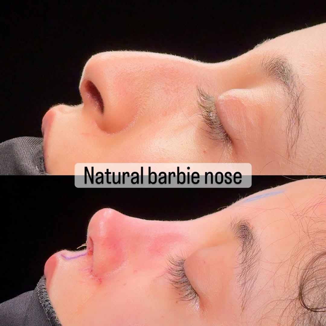 nose job in turkey, antalya-3 nose job in turkey, antalya-3