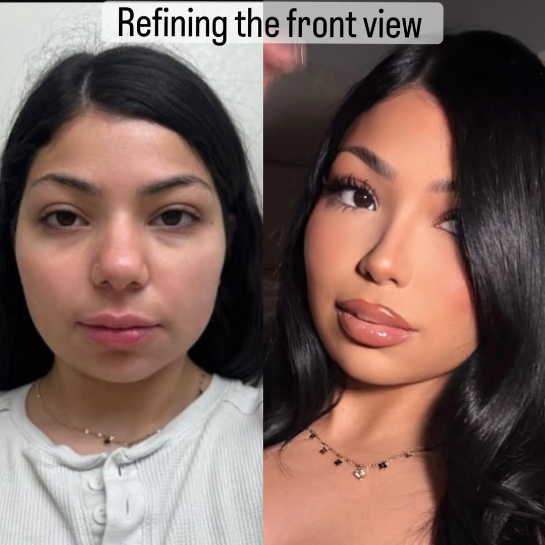 nose job in turkey, antalya-4 nose job in turkey, antalya-4