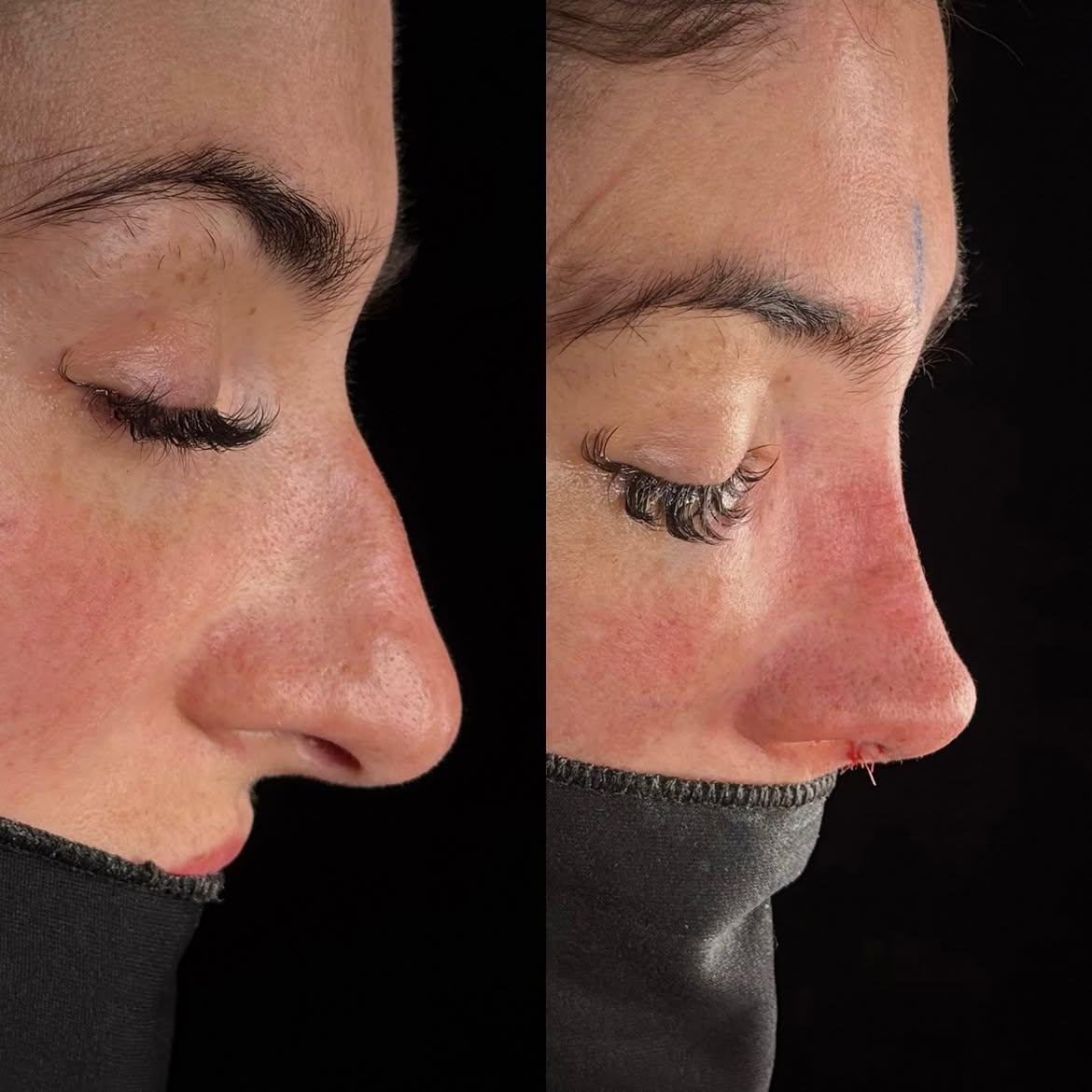 who-is-a-good-candidate-for-nose-job-turkey-antalya-1 