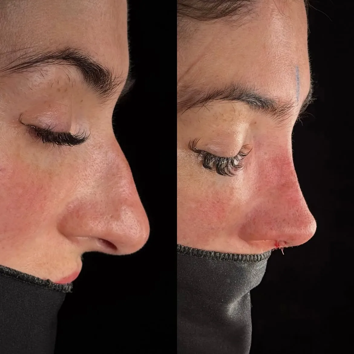 who-is-a-good-candidate-for-nose-job-turkey-antalya-1 who-is-a-good-candidate-for-nose-job-turkey-antalya-1
