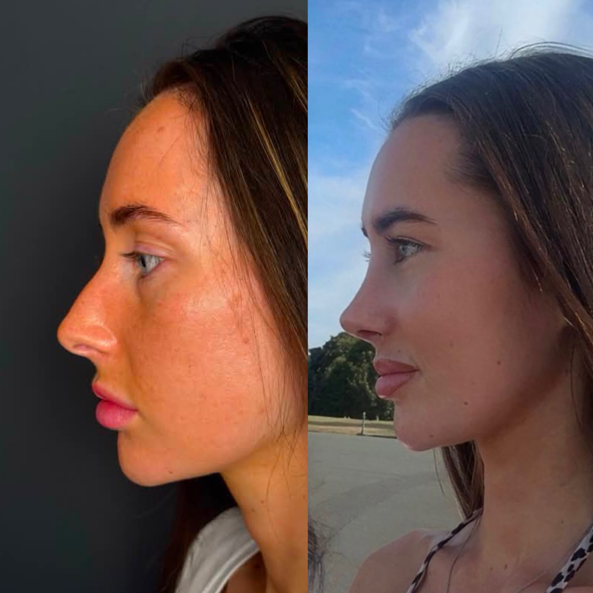 who-is-a-good-candidate-for-nose-job-turkey-antalya-10 