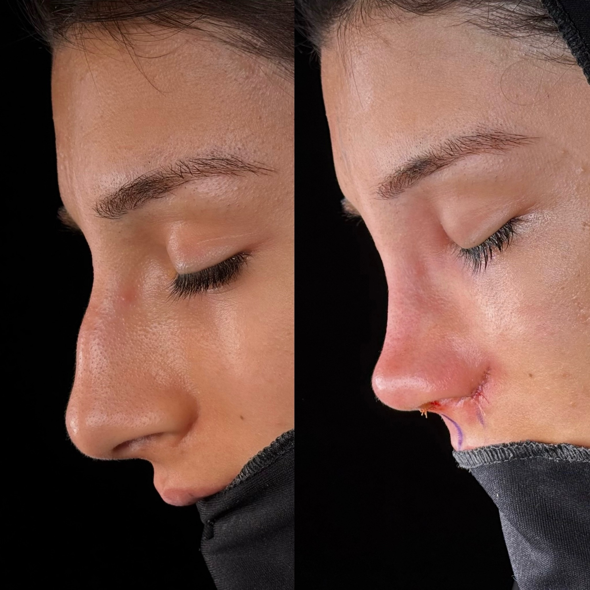 who-is-a-good-candidate-for-nose-job-turkey-antalya-11 