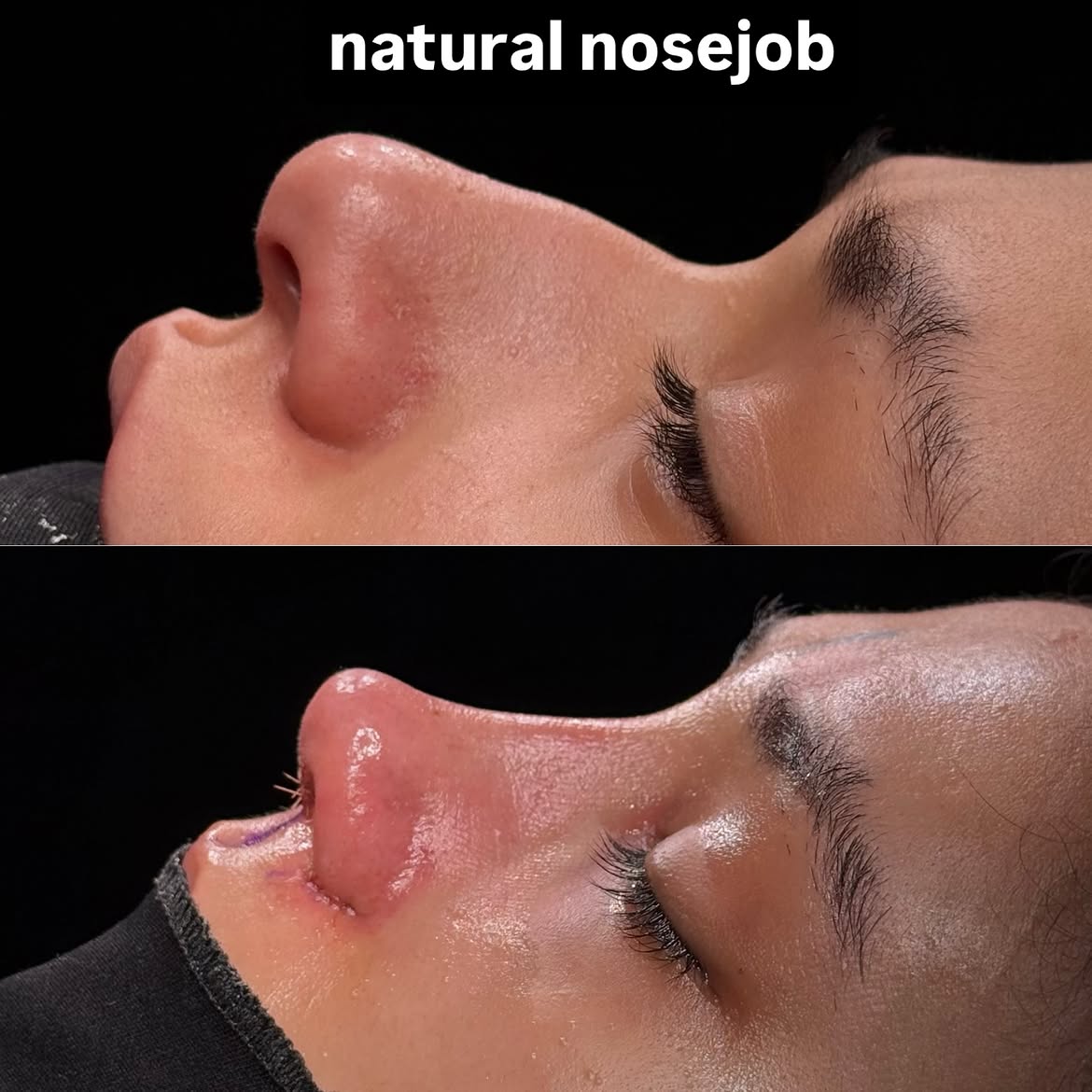 who-is-a-good-candidate-for-nose-job-turkey-antalya-13 