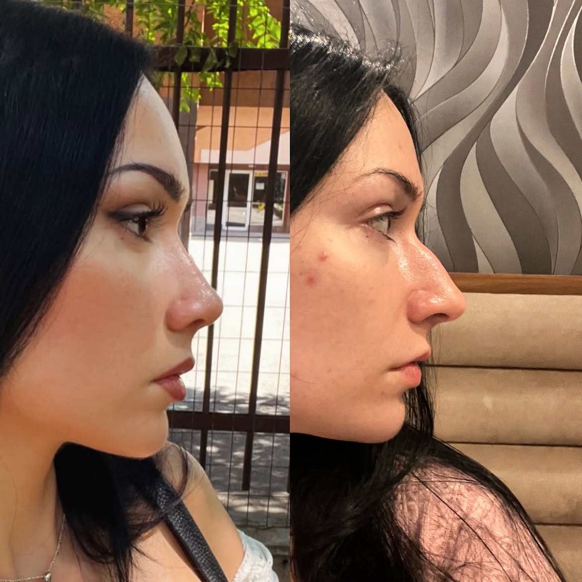 who-is-a-good-candidate-for-nose-job-turkey-antalya-3 