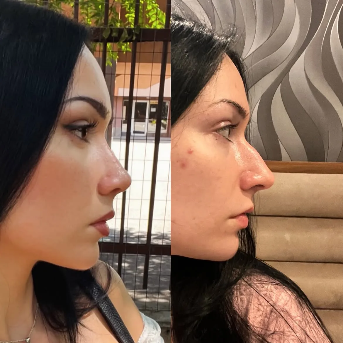 who-is-a-good-candidate-for-nose-job-turkey-antalya-3 who-is-a-good-candidate-for-nose-job-turkey-antalya-3