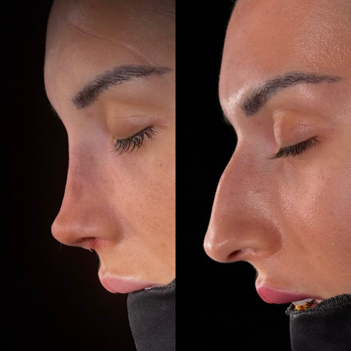who-is-a-good-candidate-for-nose-job-turkey-antalya-4 