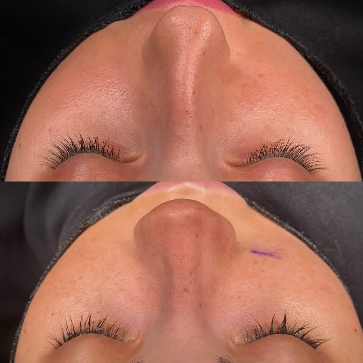 who-is-a-good-candidate-for-nose-job-turkey-antalya-5 