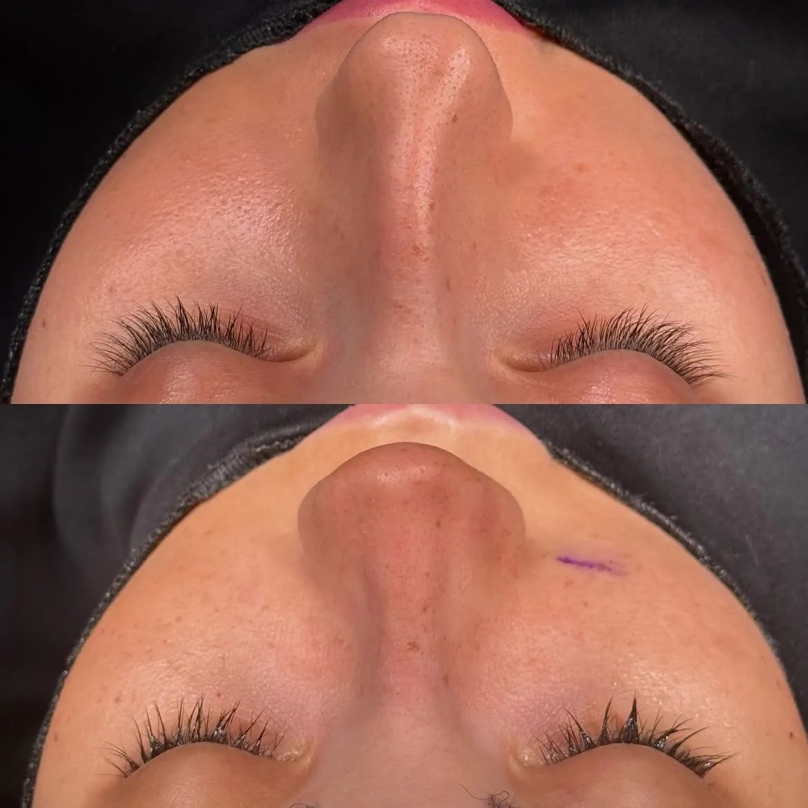 who-is-a-good-candidate-for-nose-job-turkey-antalya-5 who-is-a-good-candidate-for-nose-job-turkey-antalya-5
