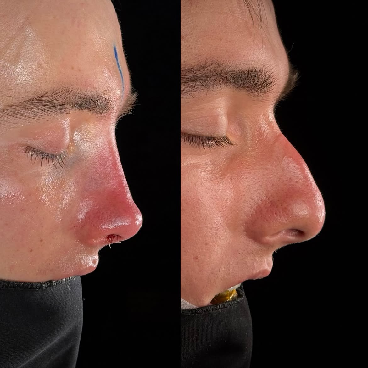 who-is-a-good-candidate-for-nose-job-turkey-antalya-6 