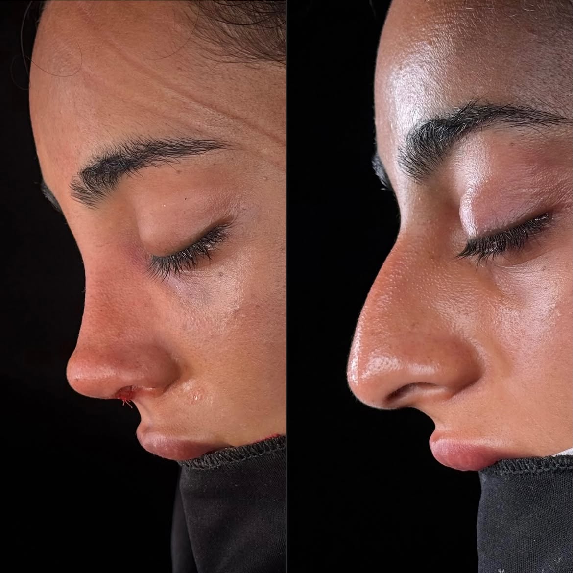 who-is-a-good-candidate-for-nose-job-turkey-antalya-7 