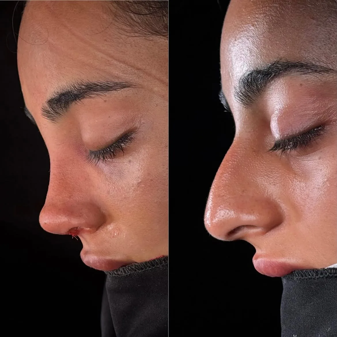 who-is-a-good-candidate-for-nose-job-turkey-antalya-7 who-is-a-good-candidate-for-nose-job-turkey-antalya-7