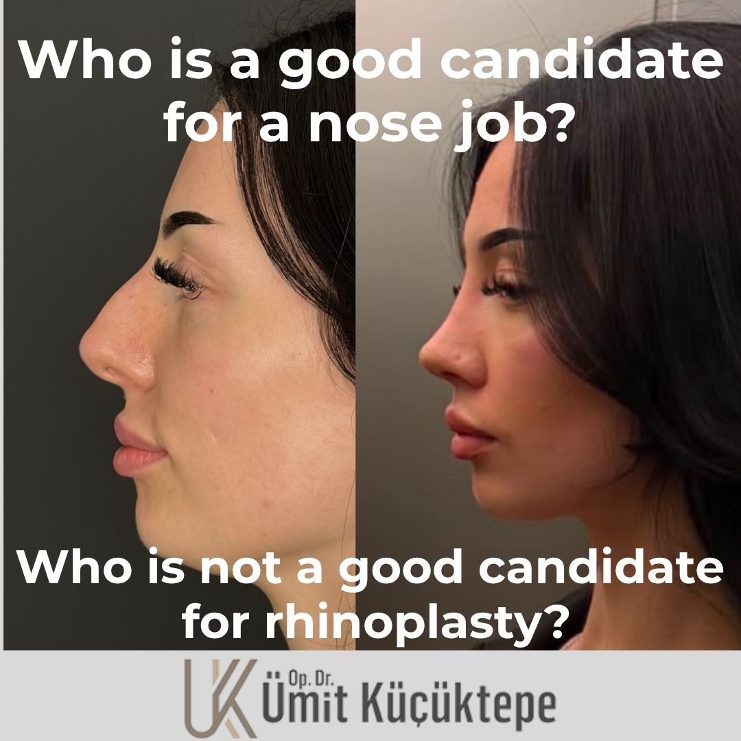 who-is-a-good-candidate-for-nose-job?