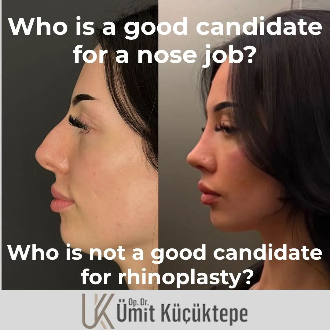 who-is-a-good-candidate-for-nose-job?