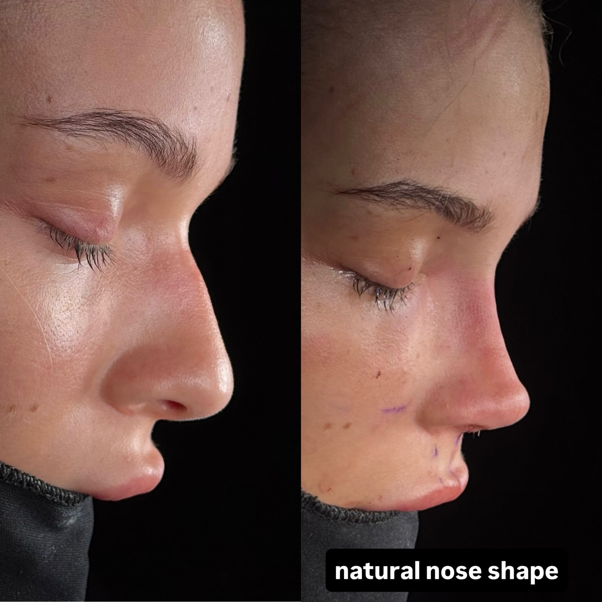 The Advantages of Nose Jobs in Turkey, Antalya