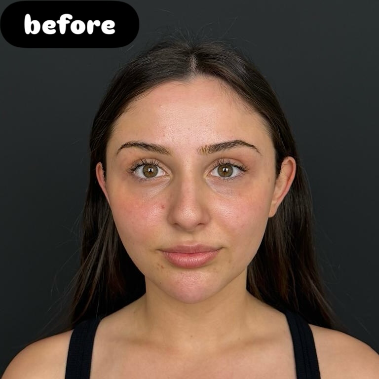 Nose Job Turkey, Antalya before and after-11