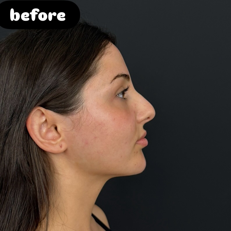 Nose Job Turkey, Antalya before and after-12