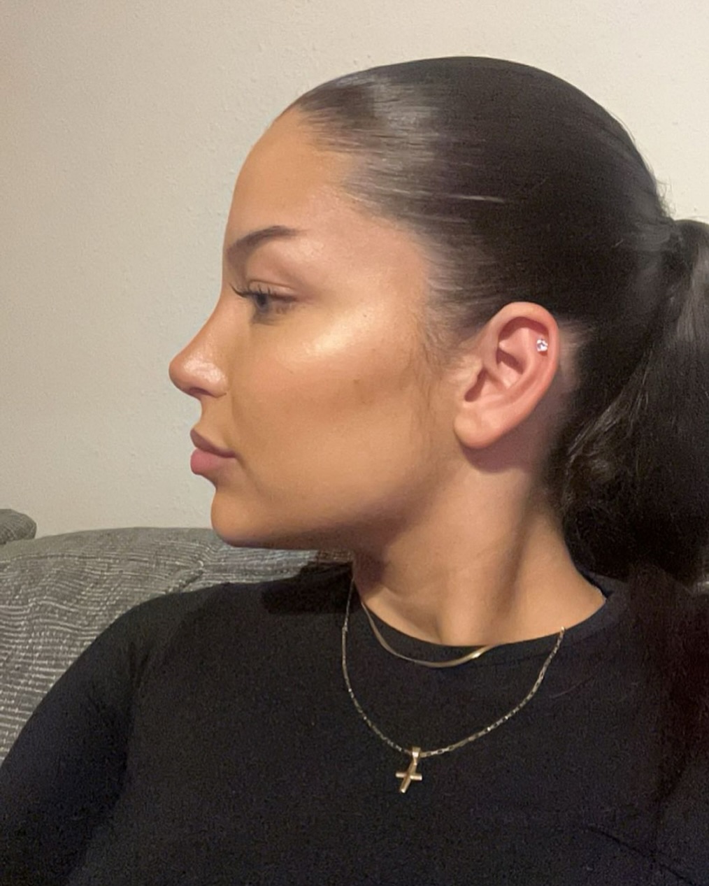 Nose Job Turkey, Antalya before and after-2