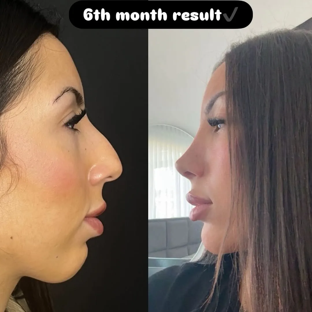 Nose Job Turkey, Antalya before and after-3