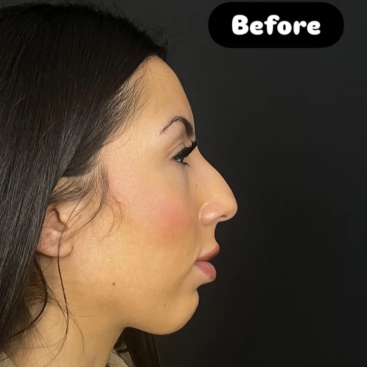 Nose Job Turkey, Antalya before and after-4
