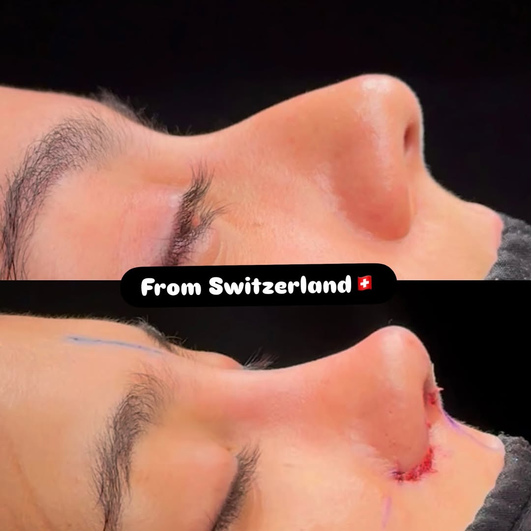 Nose Job Turkey, Antalya before and after-6