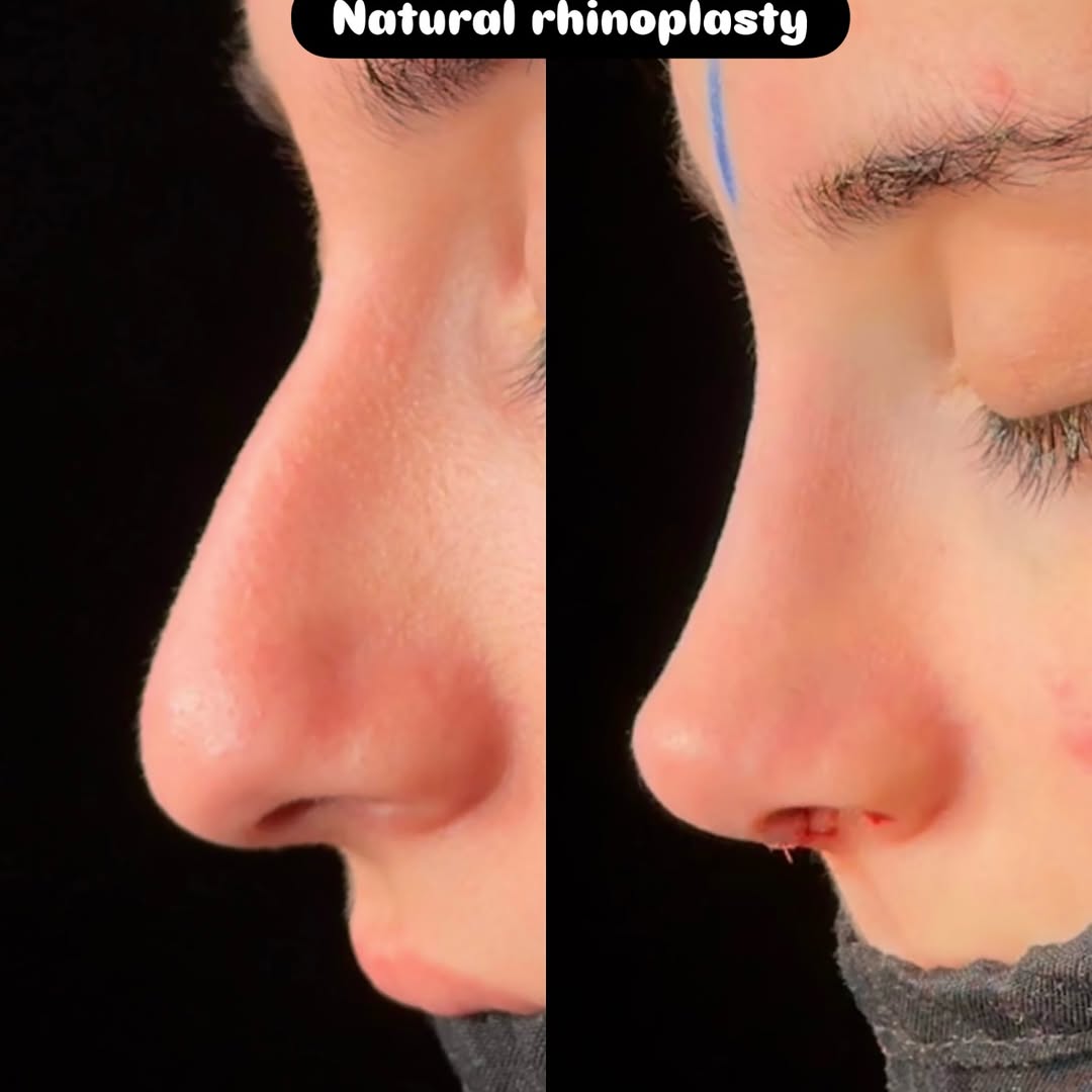 Nose Job Turkey, Antalya before and after-8