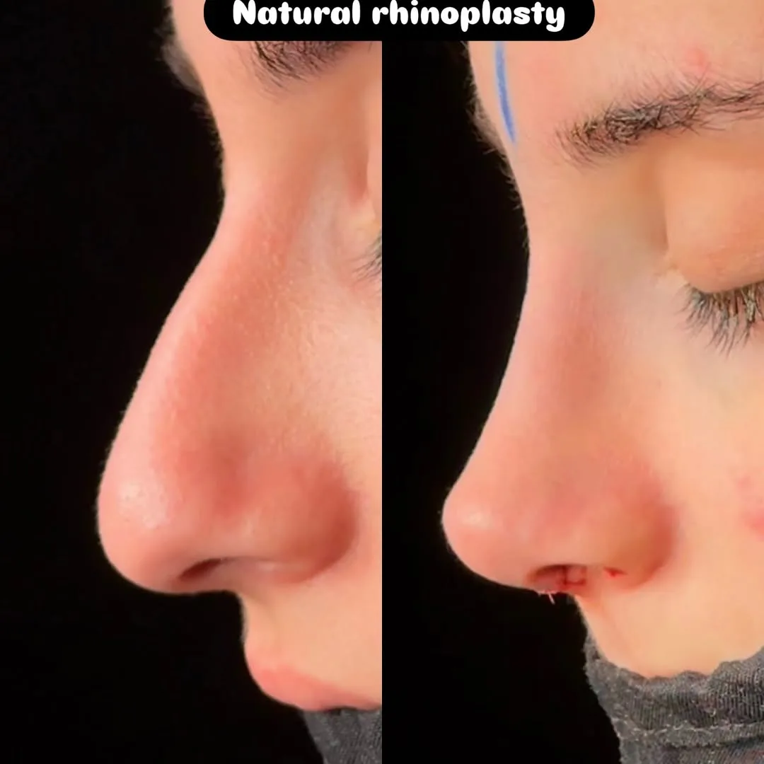 Nose Job Turkey, Antalya before and after-8