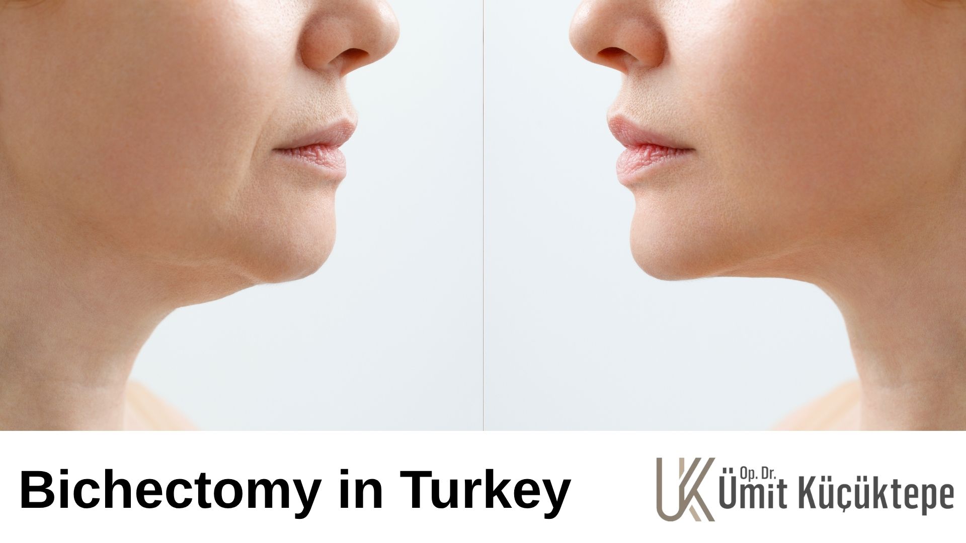 Buccal Fat Removal (Bichectomy) Buccal Fat Removal (Bichectomy) in Turkey, Antalya