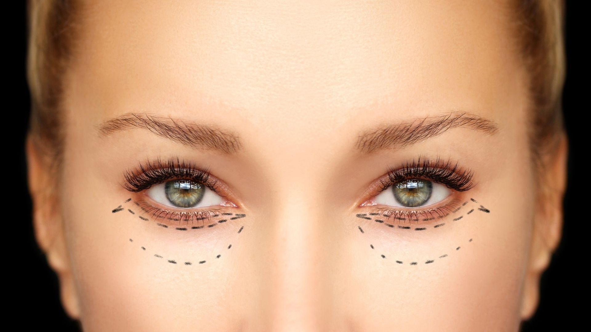 Cat eyes Surgery Cat eyes surgery