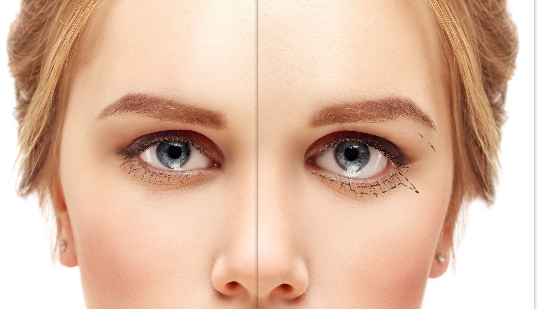 Cat eyes Surgery Cat eyes in turkey antalya