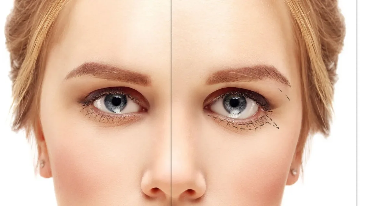 Cat eyes Surgery Cat eyes in turkey antalya