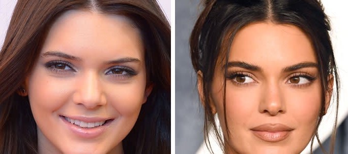 Kendall Jenner's eyes before and after Kendall Jenner's eyes before and after