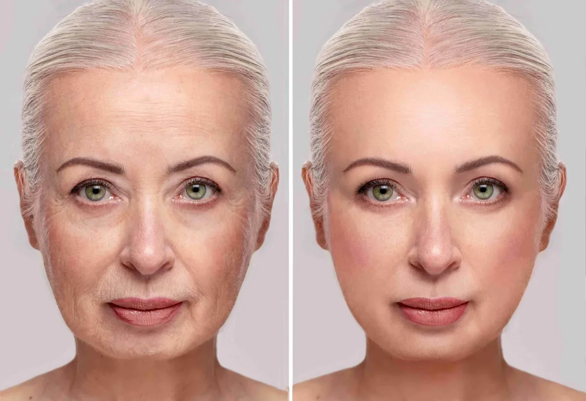 endoscopic-midface-lift-before-after-2