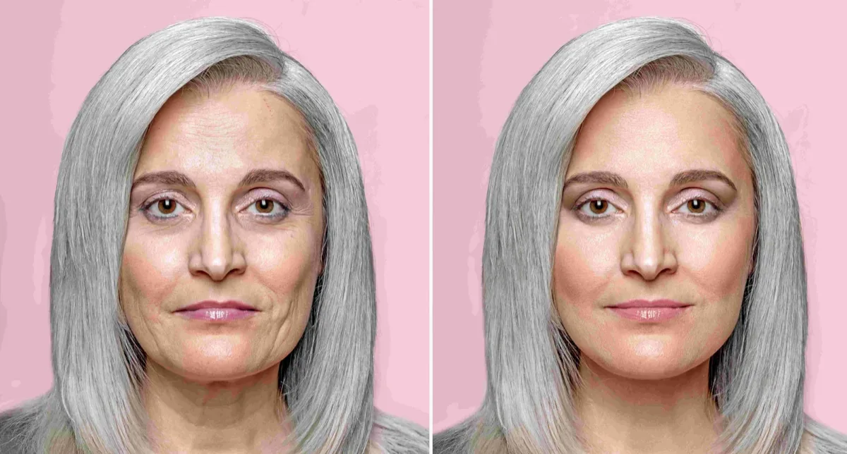 endoscopic-midface-lift-before-after-3