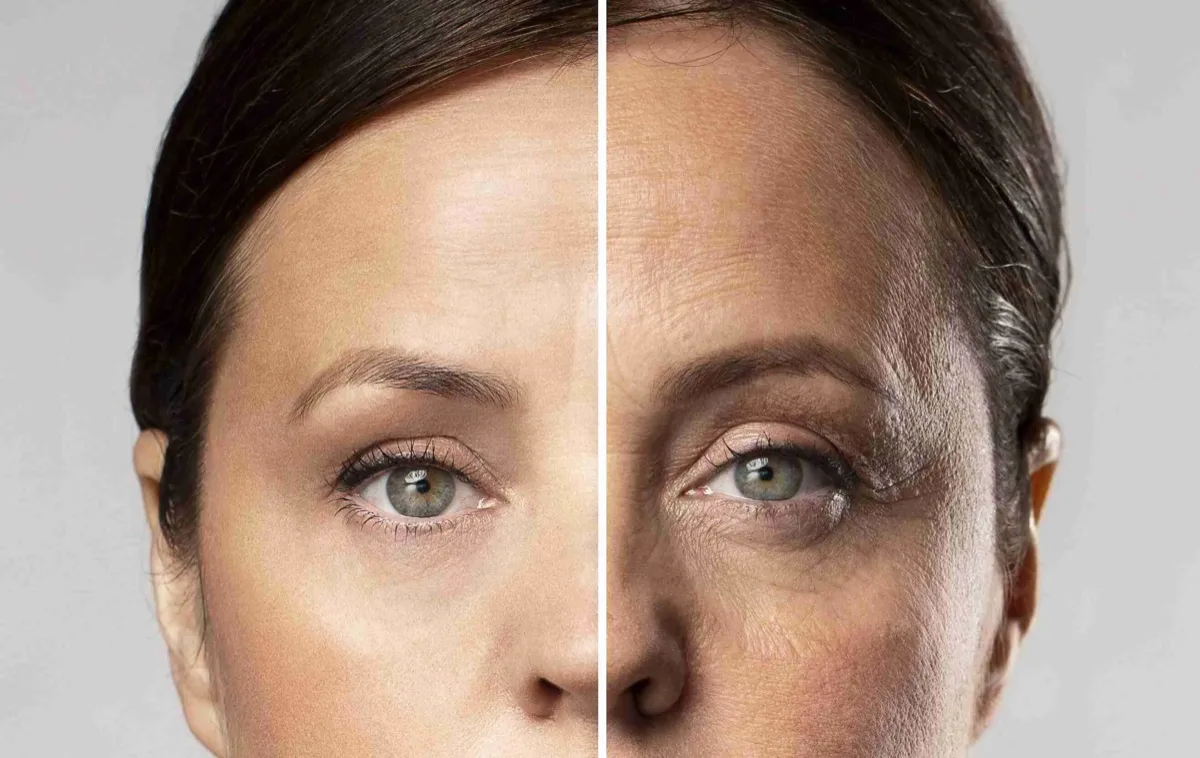 What are the benefits of an endoscopic temporal lift? What are the benefits of an endoscopic temporal lift?