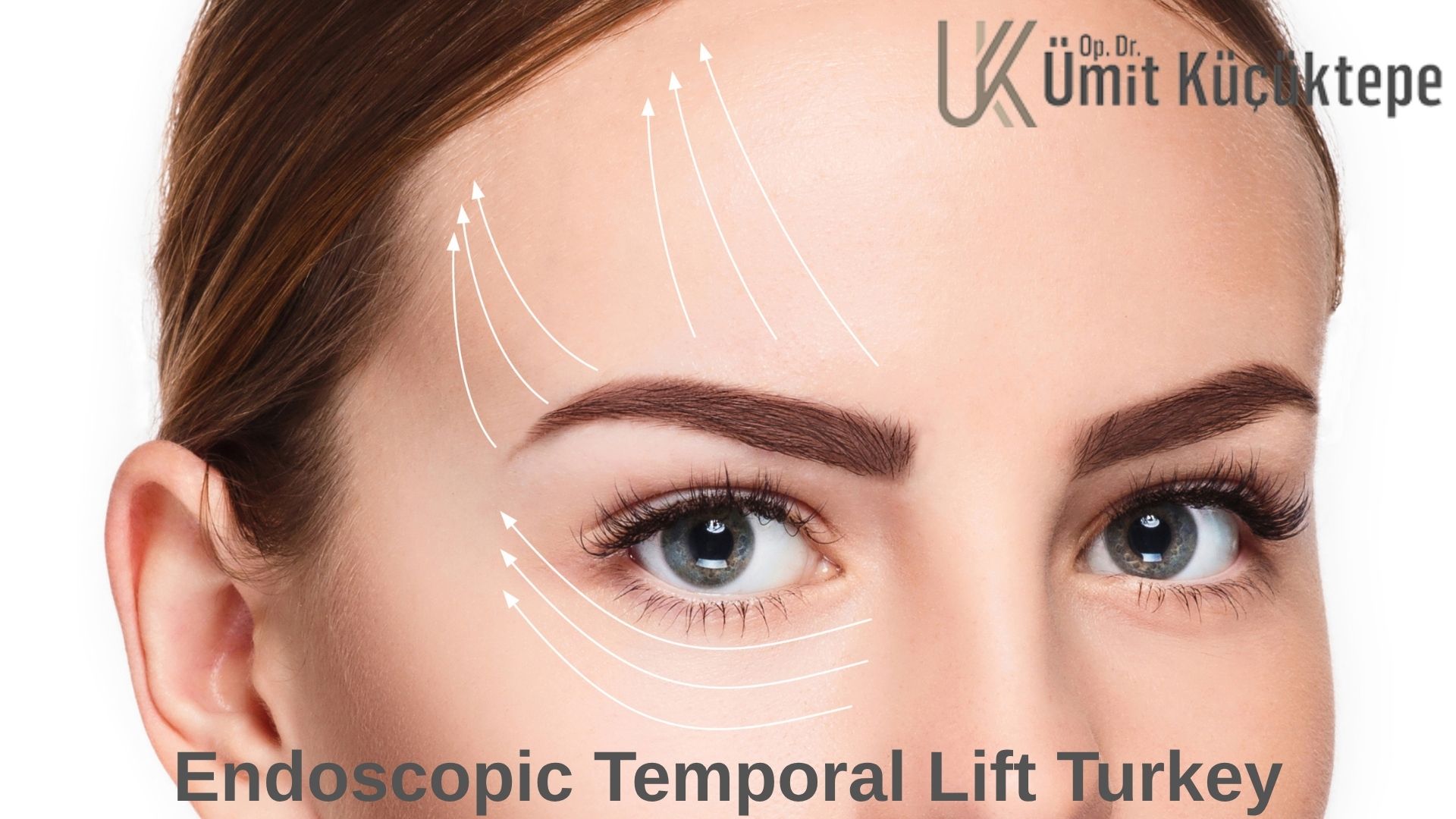 endoscopic-temporal-lift in turkey antalya