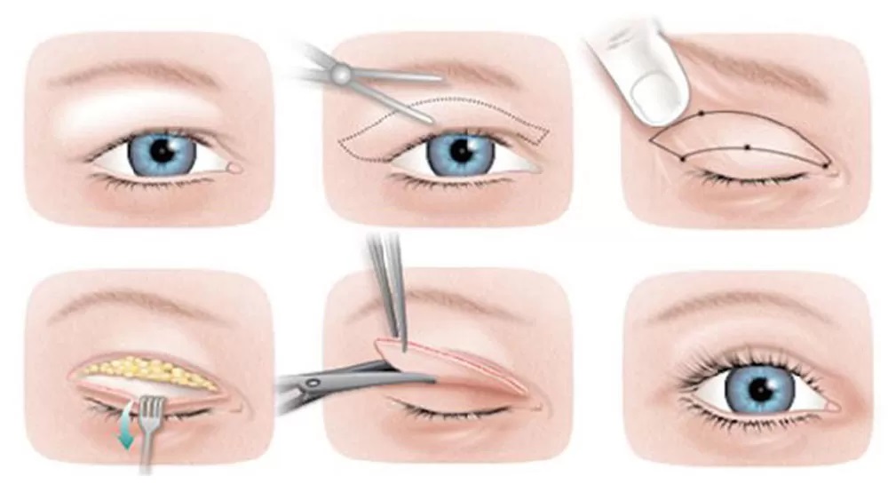 Göz Kapağı Ameliyatı Aşamaları Antalya
