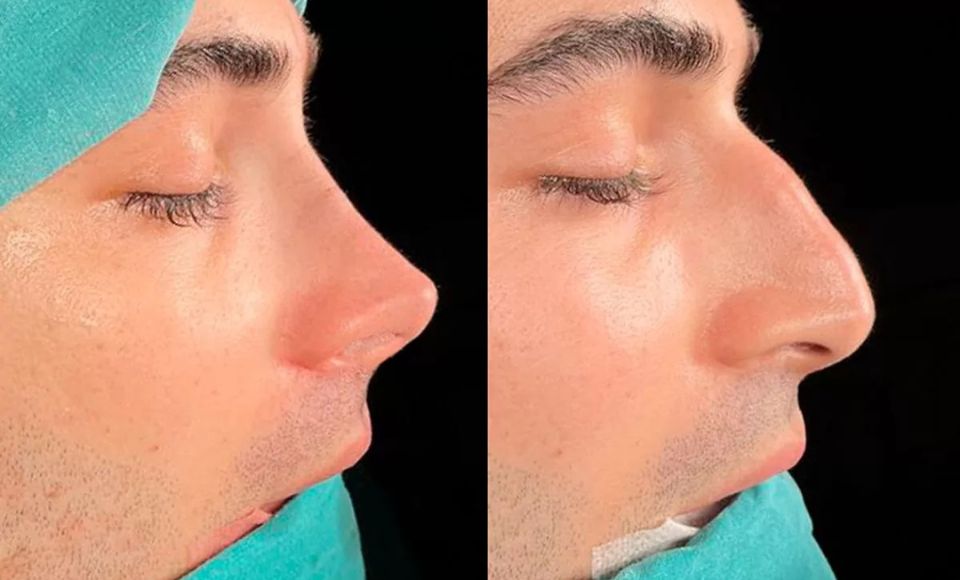 Piezo Rhinoplasty Before and After Antalya