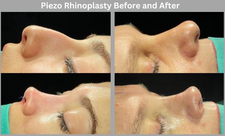 Piezo Rhinoplasty Before and After Turkey