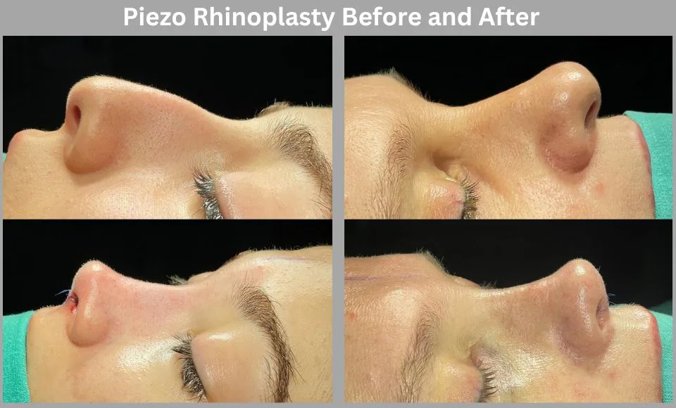 Piezo Rhinoplasty Before and After Piezo Rhinoplasty Before and After Turkey