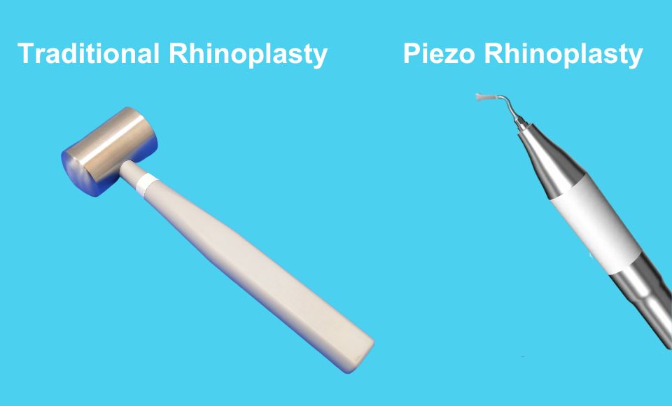 piezo rhinoplasty vs rhinoplasty